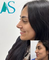 Rinoplastia - Dra. Angelica Sifontes Muñoz