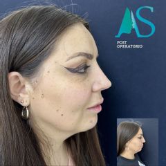 Rinoplastia - Dra. Angelica Sifontes Muñoz