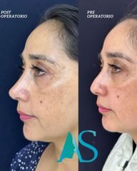 Rinoplastia - Dra. Angelica Sifontes Muñoz