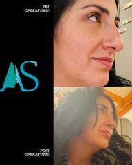 Rinoplastia - Dra. Angelica Sifontes Muñoz
