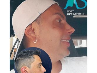 Rinoplastía antes y después - 865237