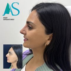 Rinoplastia - Dra. Angélica Sifontes Muñoz