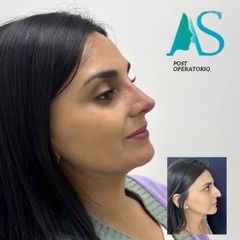 Rinoplastia - Dra. Angélica Sifontes Muñoz