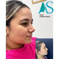 Rinoplastia - Dra. Angélica Sifontes Muñoz