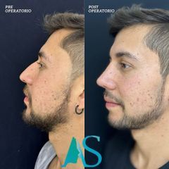 Rinoplastia - Dra. Angélica Sifontes Muñoz