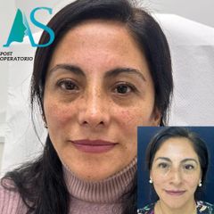 Rinoplastia - Dra. Angélica Sifontes Muñoz