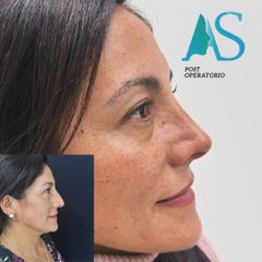 Rinoplastia - Dra. Angélica Sifontes Muñoz