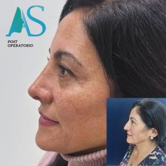 Rinoplastia - Dra. Angélica Sifontes Muñoz