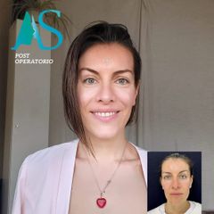 Rinoplastia - Dra. Angélica Sifontes Muñoz