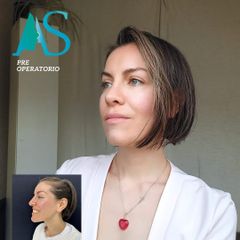 Rinoplastia - Dra. Angélica Sifontes Muñoz