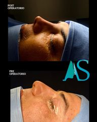 Rinoplastia - Dra. Angélica Sifontes Muñoz
