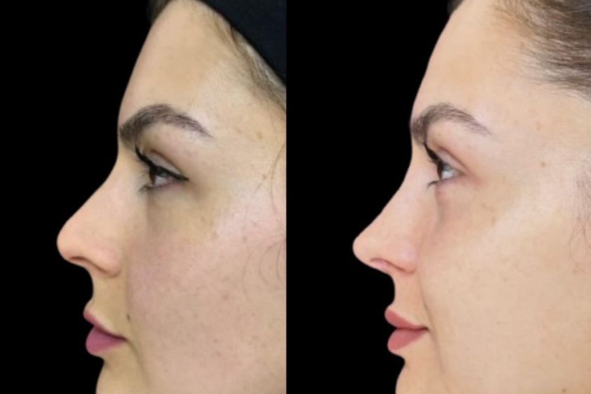 Rinoplastía antes y después - 880531