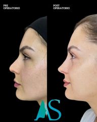 Rinoplastia - Dra. Angélica Sifontes Muñoz