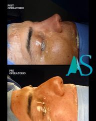 Rinoplastia Ultrasónica - Dra. Angélica Sifontes Muñoz