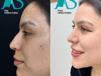 Rinoplastía antes y después - 880533