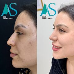 Rinoplastia Ultrasonica - Dra. Angélica Sifontes Muñoz