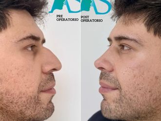 Rinoplastía antes y después - 880534