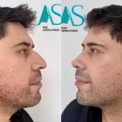 Rinoplastia Ultrasonica - Dra. Angélica Sifontes Muñoz