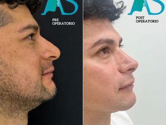 Rinoplastía antes y después - 880535