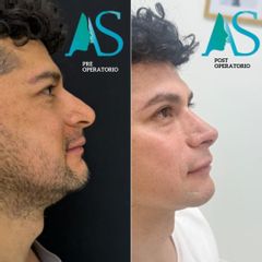 Rinoplastia Ultrasonica - Dra. Angélica Sifontes Muñoz