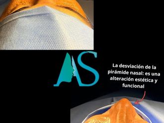 Rinoplastía antes y después - 880536