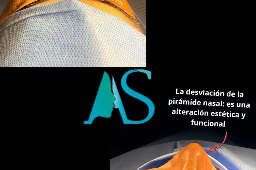 Rinoplastía antes y después - 880536