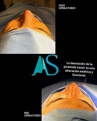Rinoplastia Ultrasonica - Dra. Angélica Sifontes Muñoz