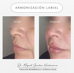 Aumento de labios - Dr. Miguel Enrique Sánchez Hechavarria