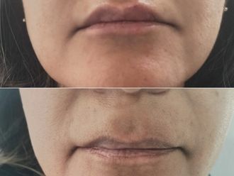 Aumento de labios antes y después - 874420