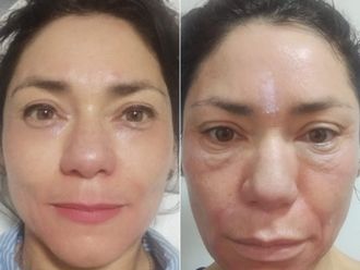 Rejuvenecimiento facial antes y después - 874421