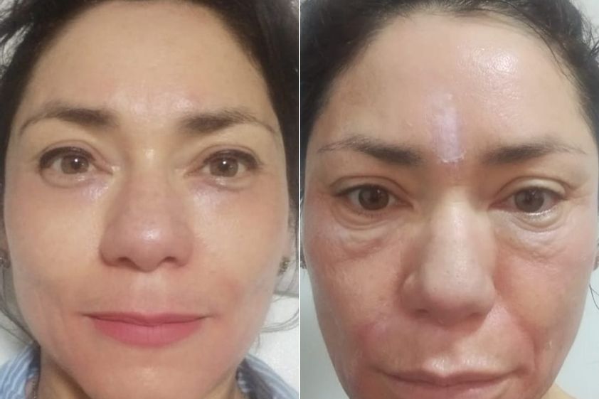 Rejuvenecimiento facial antes y después - 874421