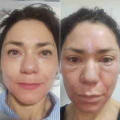 Rejuvenecimiento facial con bioestimuladores - Dr. Miguel Enrique Sánchez Hechavarria