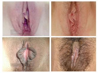 Labioplastia antes y después - 501765