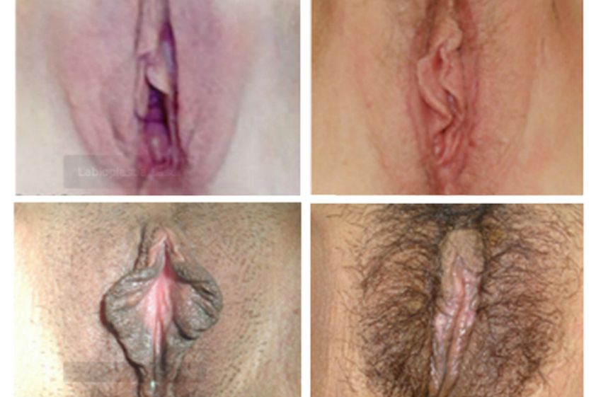 Labioplastia antes y después - 501765