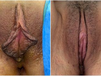 Labioplastia antes y después - 827864