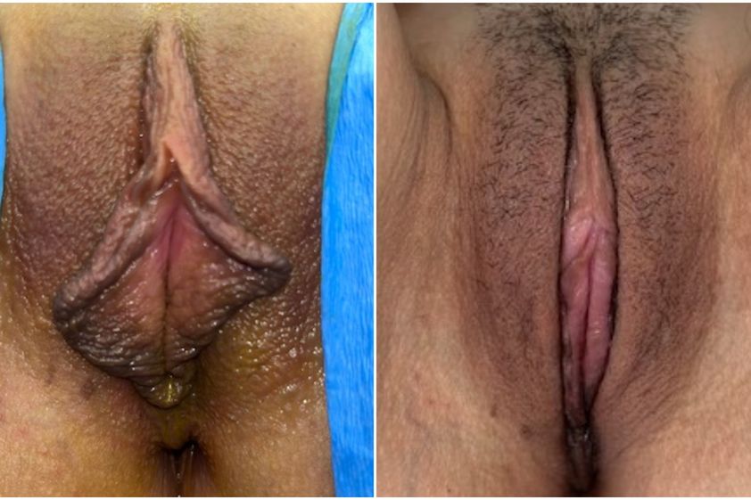 Labioplastia antes y después - 827864