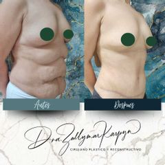 Abdominoplastia - Dra. Zullymar Karpyn
