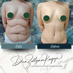 Abdominoplastia - Dra. Zullymar Karpyn