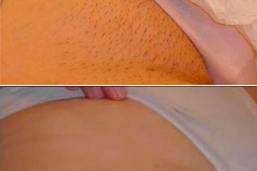 Depilación Láser antes y después - 662684