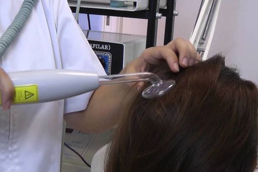 Alopecia antes y después - 617897