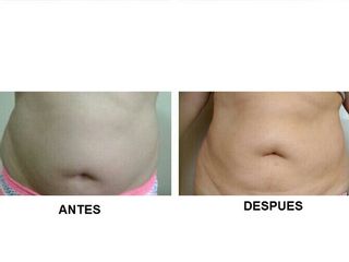 Tratamiento Reductivo, Reafirmante y Levantamiento de Abdomen