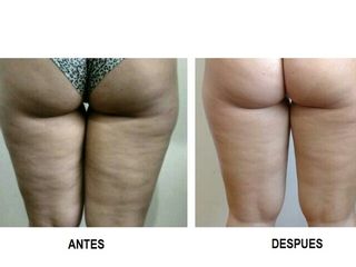 Celulitis 