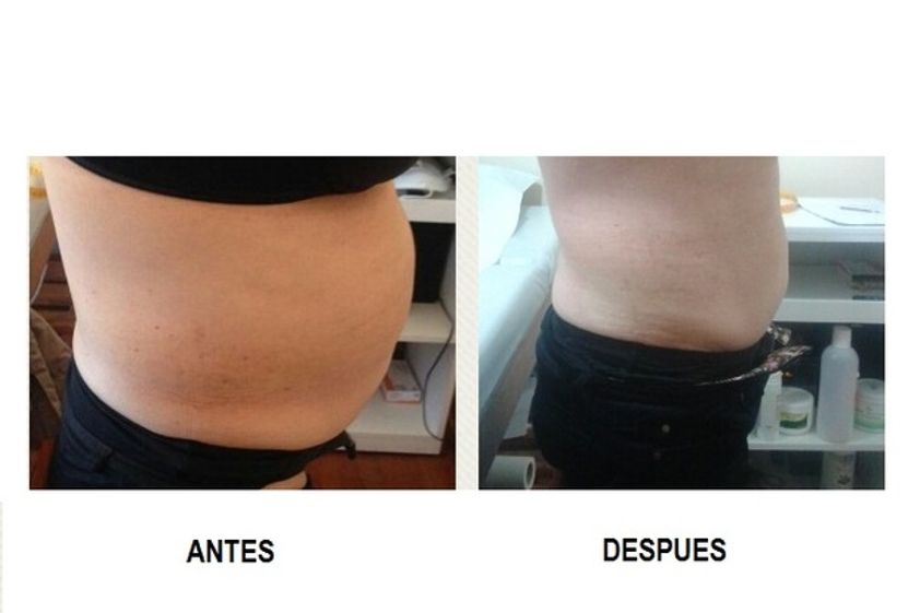 Cavitación antes y después - 617904