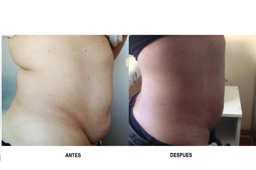 Radiofrecuencia antes y después - 617905