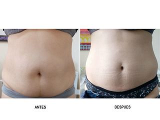Liposucción 