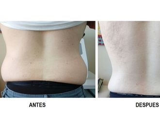Cavitación antes y después - 618483