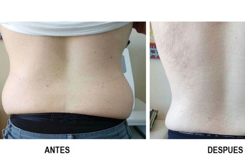 Cavitación antes y después - 618483