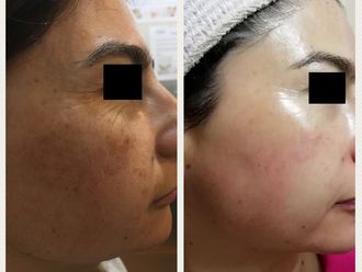 Peeling - 632388