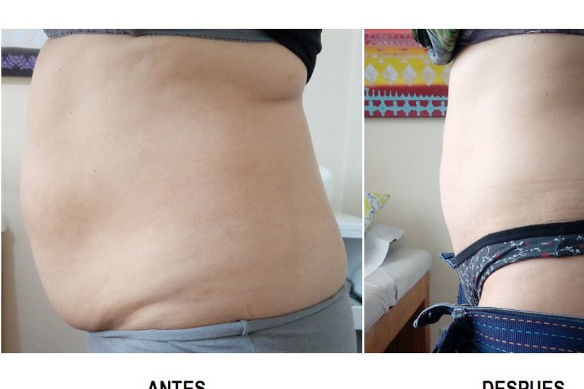 Cavitación antes y después - 633061