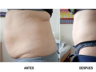 Tratamiento Reductivo- Reafirmante (Guatita delantal) 